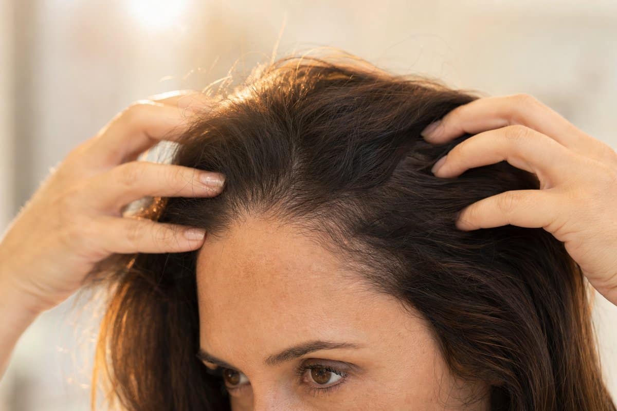Woman showing visible hair regrowth and density improvement after PRP or exosome therapy