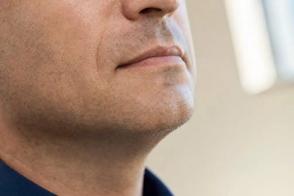 Confident man in his 40s with smooth clear skin after Morpheus8 acne scar treatment at Miami Lakes Med Spa